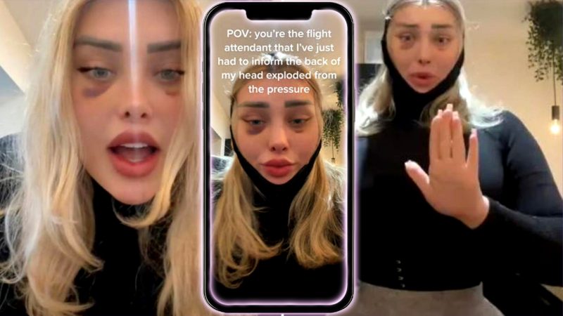 Onlyfans Model Explains How Her Head Exploded Mid Flight After Cat Eye Surgery